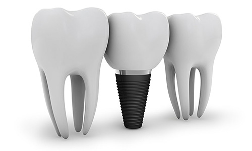 Effective Dental Implant in Riverside CA